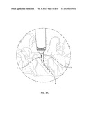 PEDICLE DRILL GUIDE FOR SPINAL SURGERY diagram and image