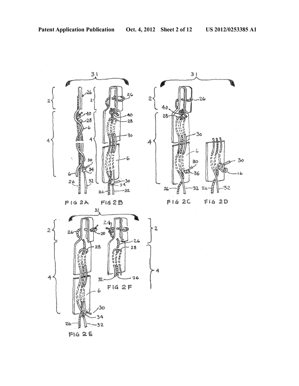 CLOSURE MEDICAL DEVICE AND DELIVERY MECHANISM - diagram, schematic, and image 03