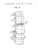 INTERVERTEBRAL IMPLANT WITH INTEGRATED FIXATION diagram and image