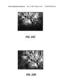 PORTABLE SELF-RETINAL IMAGING DEVICE diagram and image