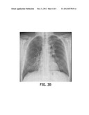 BONE SUPPRESSION IN X-RAY RADIOGRAMS diagram and image