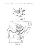 RECTAL BALLOON WITH RADIATION SENSOR AND/OR MARKERS diagram and image