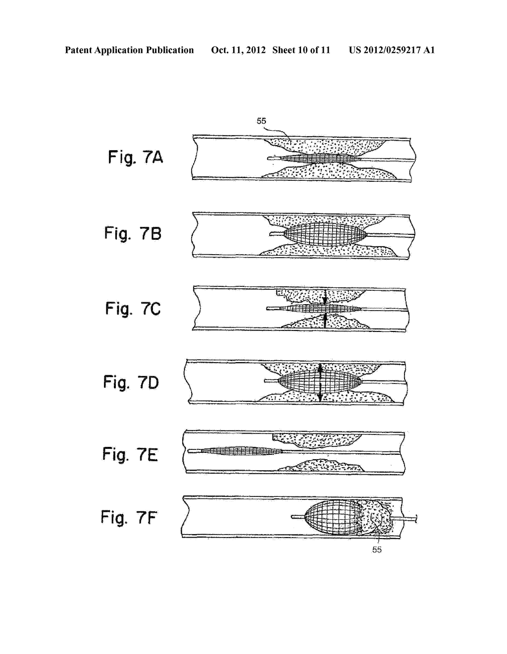 BIOFEEDBACK CONTROLLED DEFORMATION OF SINUS OSTIA - diagram, schematic, and image 11