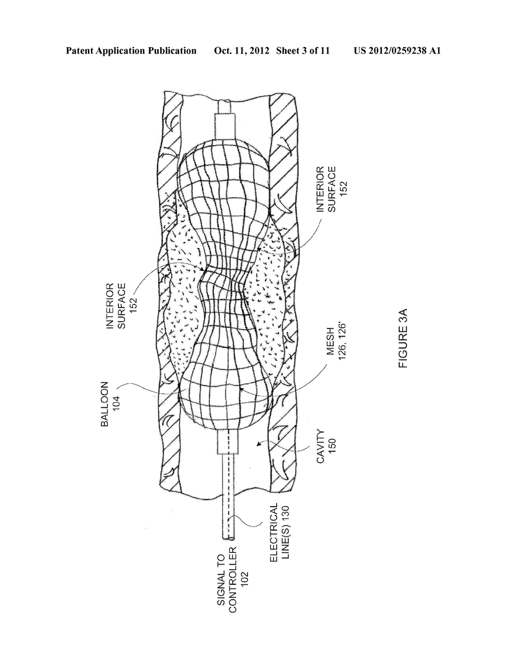 Anatomical Visualization With Electrically Conductive Balloon Catheter - diagram, schematic, and image 04