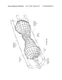 Anatomical Visualization With Electrically Conductive Balloon Catheter diagram and image