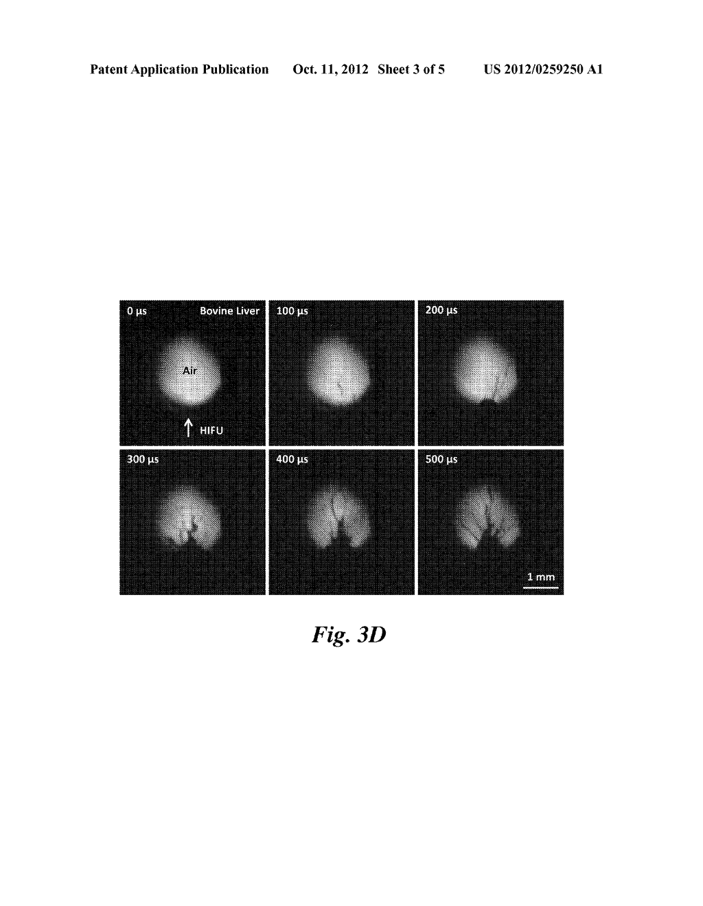 METHODS OF SOFT TISSUE EMULSIFICATION USING A MECHANISM OF ULTRASONIC     ATOMIZATION INSIDE GAS OR VAPOR CAVITIES AND ASSOCIATED SYSTEMS AND     DEVICES - diagram, schematic, and image 04