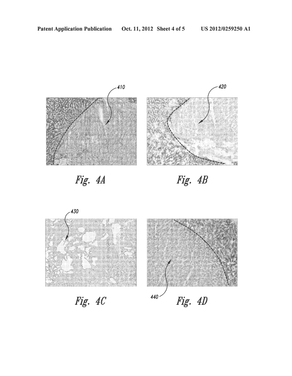METHODS OF SOFT TISSUE EMULSIFICATION USING A MECHANISM OF ULTRASONIC     ATOMIZATION INSIDE GAS OR VAPOR CAVITIES AND ASSOCIATED SYSTEMS AND     DEVICES - diagram, schematic, and image 05