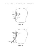 Endoscopic Methods and Devices for Transnasal Procedures diagram and image