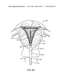 SYSTEMS AND METHODS FOR ENDOMETRIAL ABLATION diagram and image