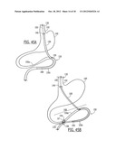 GASTRIC BYPASS DEVICES AND PROCEDURES diagram and image