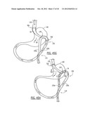 GASTRIC BYPASS DEVICES AND PROCEDURES diagram and image