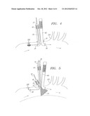 DIRECT ACCESS ATHERECTOMY DEVICES AND METHODS OF USE diagram and image