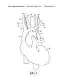 UNIDIRECTIONAL NEURAL STIMULATION SYSTEMS, DEVICES AND METHODS diagram and image