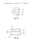 Implantable Intervertebral Fusion Device diagram and image