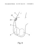 VASECTOMY DEVICES, KITS, AND METHODS OF USING SAME diagram and image