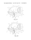 SYSTEM AND METHOD FOR PERCUTANEOUS PALATE REMODELING diagram and image