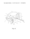 SYSTEM AND METHOD FOR PERCUTANEOUS PALATE REMODELING diagram and image