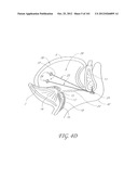 SYSTEM AND METHOD FOR PERCUTANEOUS PALATE REMODELING diagram and image