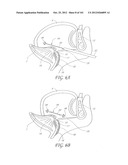 SYSTEM AND METHOD FOR PERCUTANEOUS PALATE REMODELING diagram and image