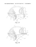 SYSTEM AND METHOD FOR PERCUTANEOUS PALATE REMODELING diagram and image