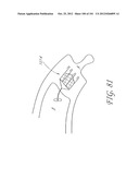 SYSTEM AND METHOD FOR PERCUTANEOUS PALATE REMODELING diagram and image