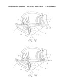 SYSTEM AND METHOD FOR PERCUTANEOUS PALATE REMODELING diagram and image