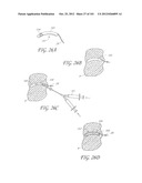 SYSTEM AND METHOD FOR PERCUTANEOUS PALATE REMODELING diagram and image