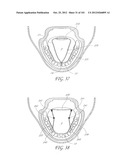 SYSTEM AND METHOD FOR PERCUTANEOUS PALATE REMODELING diagram and image