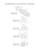 SYSTEM AND METHOD FOR PERCUTANEOUS PALATE REMODELING diagram and image