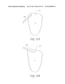 SYSTEM AND METHOD FOR PERCUTANEOUS PALATE REMODELING diagram and image