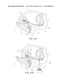 SYSTEM AND METHOD FOR PERCUTANEOUS PALATE REMODELING diagram and image