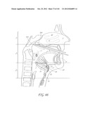 SYSTEM AND METHOD FOR PERCUTANEOUS PALATE REMODELING diagram and image