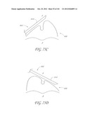 SYSTEM AND METHOD FOR PERCUTANEOUS PALATE REMODELING diagram and image