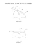 SYSTEM AND METHOD FOR PERCUTANEOUS PALATE REMODELING diagram and image