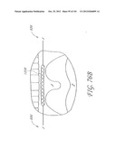 SYSTEM AND METHOD FOR PERCUTANEOUS PALATE REMODELING diagram and image