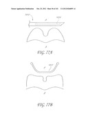 SYSTEM AND METHOD FOR PERCUTANEOUS PALATE REMODELING diagram and image