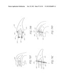 SYSTEM AND METHOD FOR PERCUTANEOUS PALATE REMODELING diagram and image