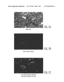 CARDIAC MUSCLE REPAIR OR REGENERATION USING BONE MARROW-DERIVED STEM CELLS diagram and image