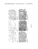 NATRIURETIC PEPTIDE RECEPTOR AS A BIOMARKER FOR DIAGNOSIS AND PROGNOSIS OF     CANCER diagram and image