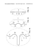 METHODS FOR DETECTION OF CARDIAC RHYTHM DISORDERS USING BASKET STYLE     CARDIAC MAPPING CATHETER diagram and image