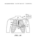 Robust Rate Calculation in an Implantable Cardiac Stimulus or Monitoring     Device diagram and image