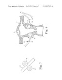 Fibroid Treatment System and Method diagram and image