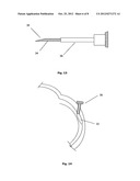 DEVICE FOR OCULAR ACCESS diagram and image