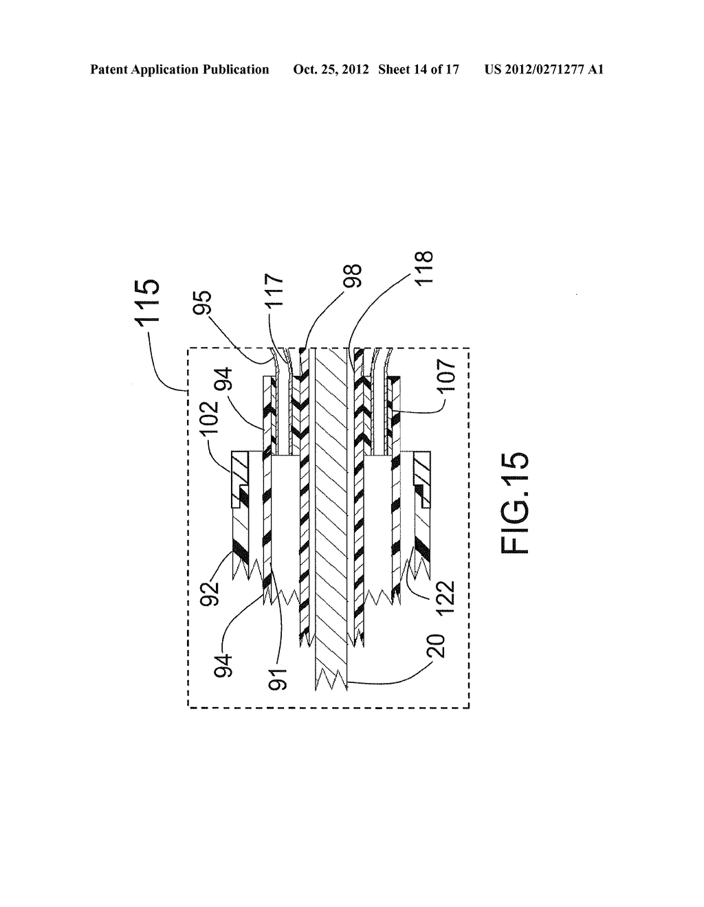 EXPANDABLE CATHETER SYSTEM FOR PERI-OSTIAL INJECTION AND MUSCLE AND NERVE     FIBER ABLATION - diagram, schematic, and image 15