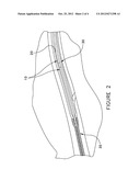 Method of Improved Vein Closure diagram and image