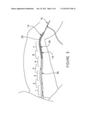 Method of Improved Vein Closure diagram and image