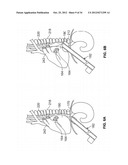 METHOD AND DEVICES FOR COAGULATION OF TISSUE diagram and image