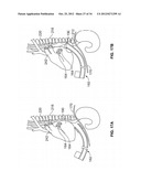 METHOD AND DEVICES FOR COAGULATION OF TISSUE diagram and image