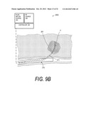 MEDICAL INSTRUMENT AND METHOD OF USE diagram and image