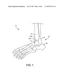 ORTHOPEDIC SURGICAL GUIDE diagram and image